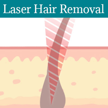 Saint Peters, MO Laser Hair Removal