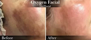 Oxygen Facial (cheeks) Before & After