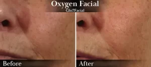 Oxygen Facial (face) Before & After