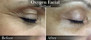 Oxygen Facial (eyes) Before & After