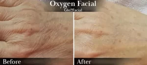 Oxygen Facial (hands) Before & After