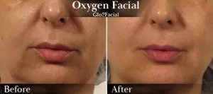 Oxygen Facial (mouth) Before & After